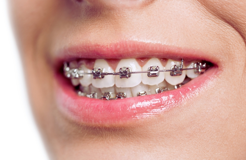 why metal braces remain a popular orthodontic option