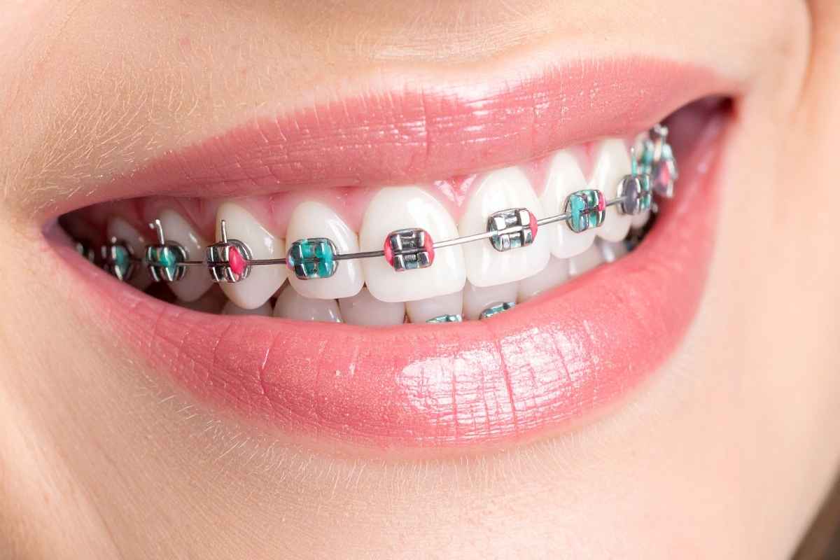 Ceramic braces